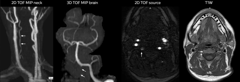 headneck mra in ed