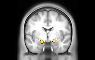 MultiBand SENSE fMRI faces vs places subcort coronal