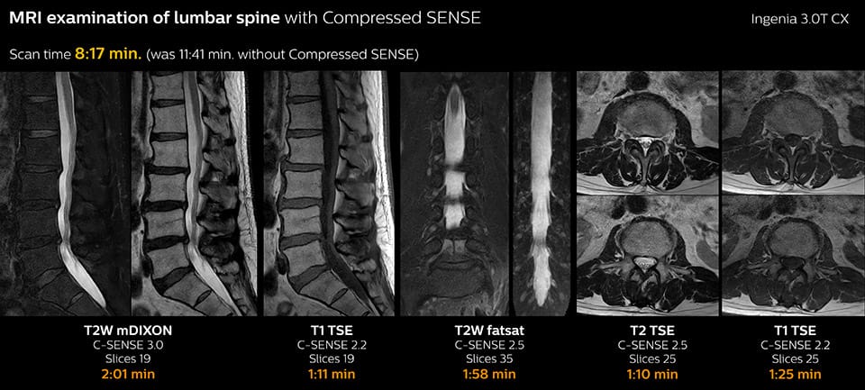 MRI examination of lumbar spine with Compressed SENSE
